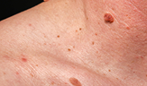 big birthmark on man's neck
