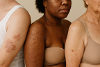 diverse skin conditions