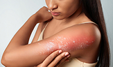 eczema on a lady's body