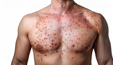 man's chest with skin condition - red spots