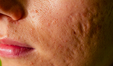 post acne scars, red festering pimples, on a young woman's face