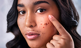 woman with acne pimple